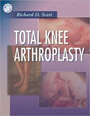 Total Knee Arthroplasty